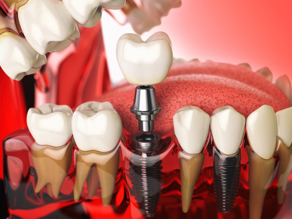 Dental Implant Morachis Dental Advanced