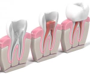 root canal therapy dental naco