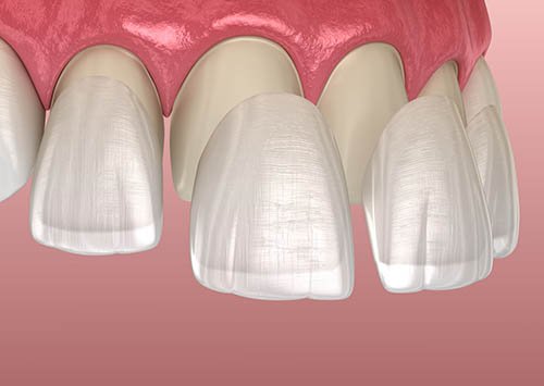 veneers morachis dental advanced